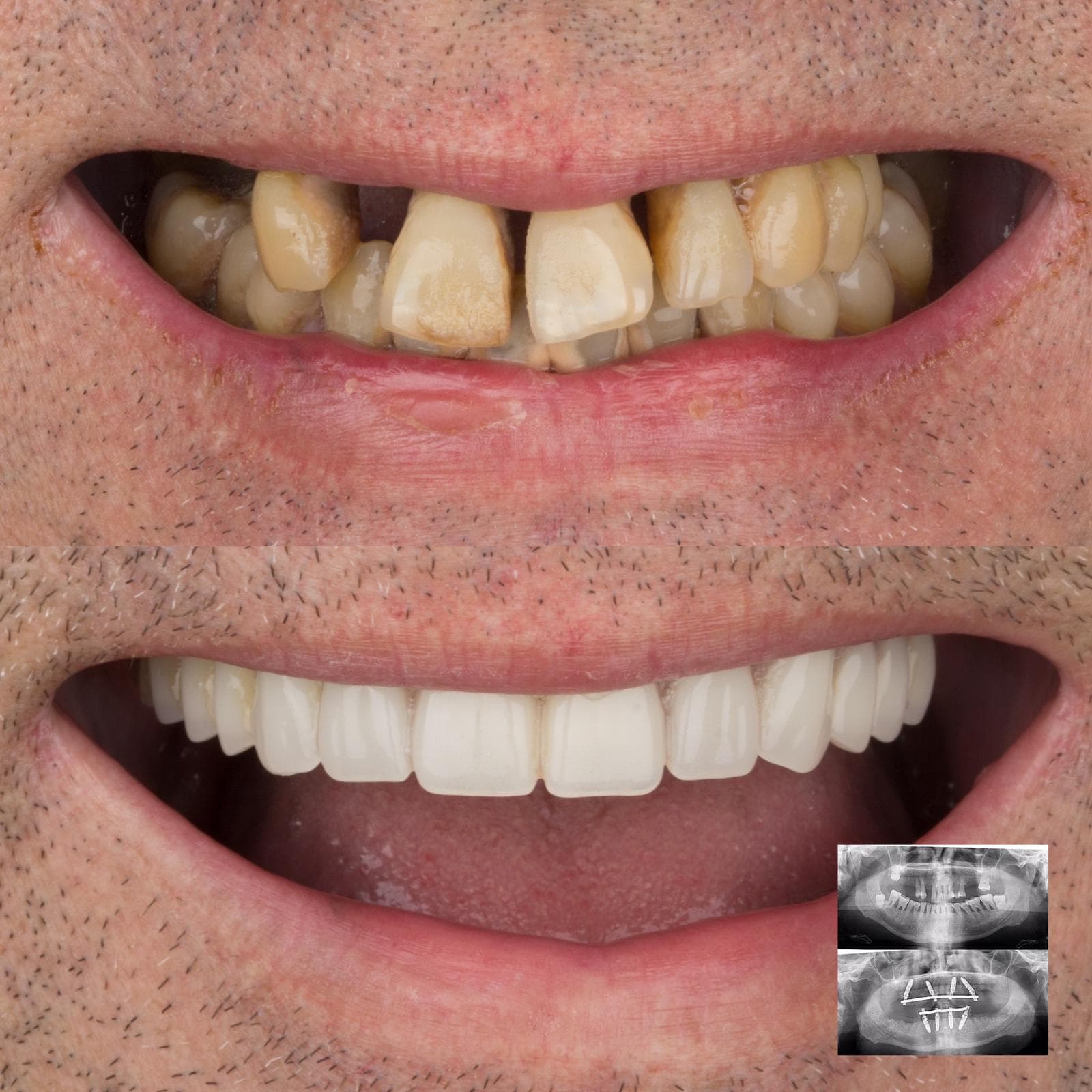 Before and after — All-on-4 full-arch implants, DentaGlobal, Turkey