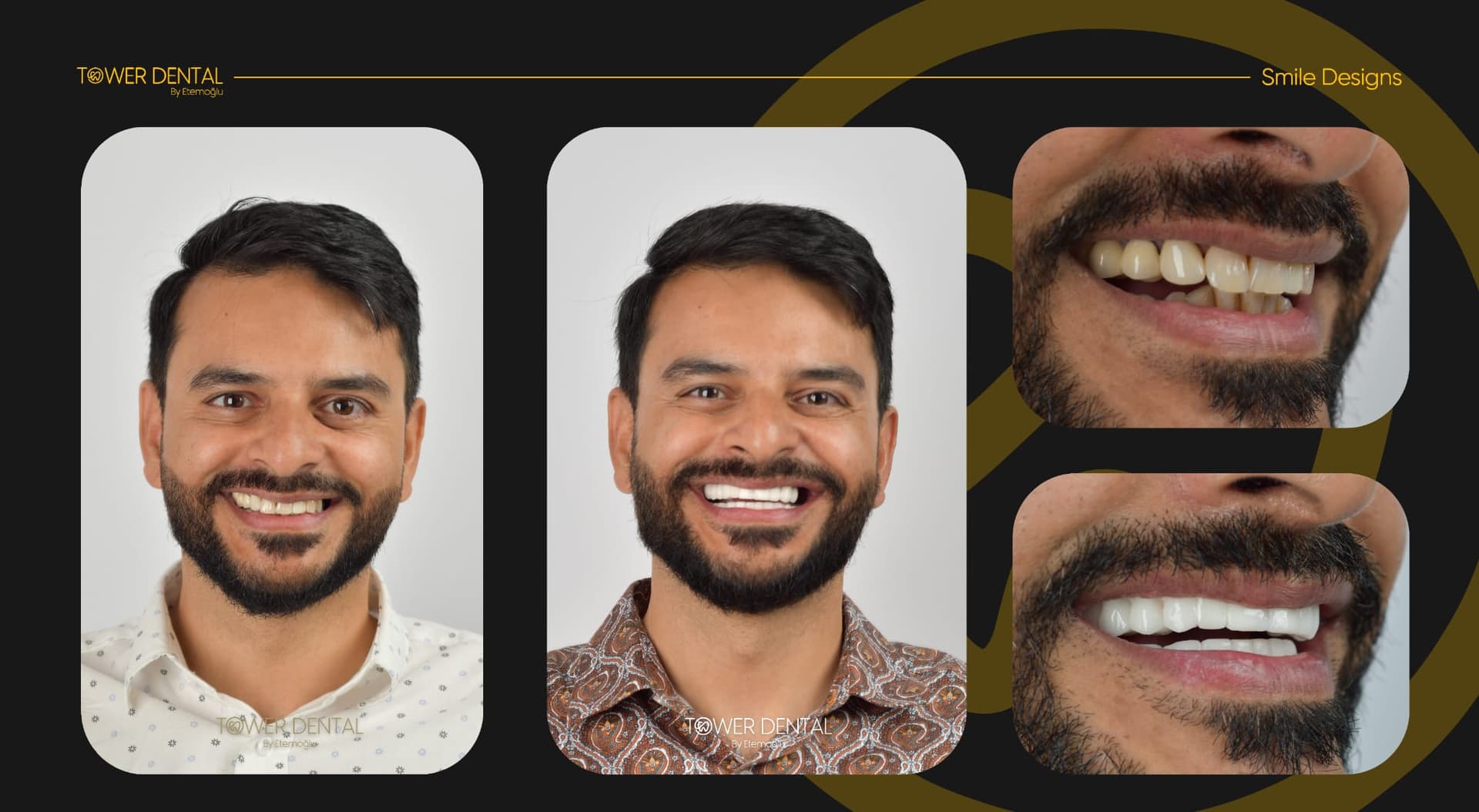 Before and after — Hollywood smile · E-max veneers, Tower Dental Clinic, Istanbul