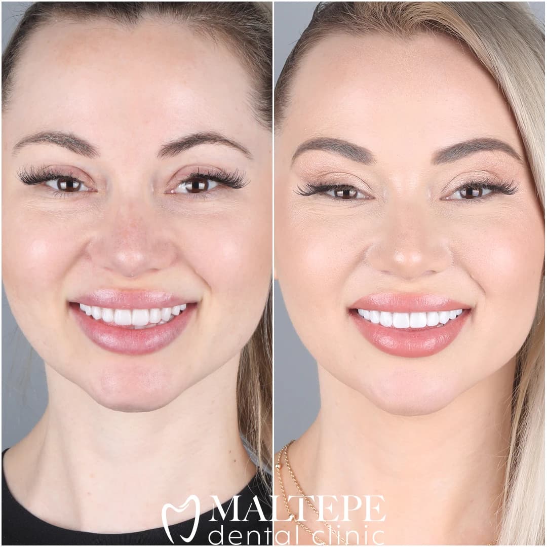 Hollywood Smile Package