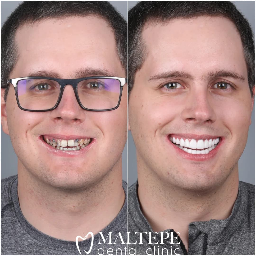 Crown Restoration Package