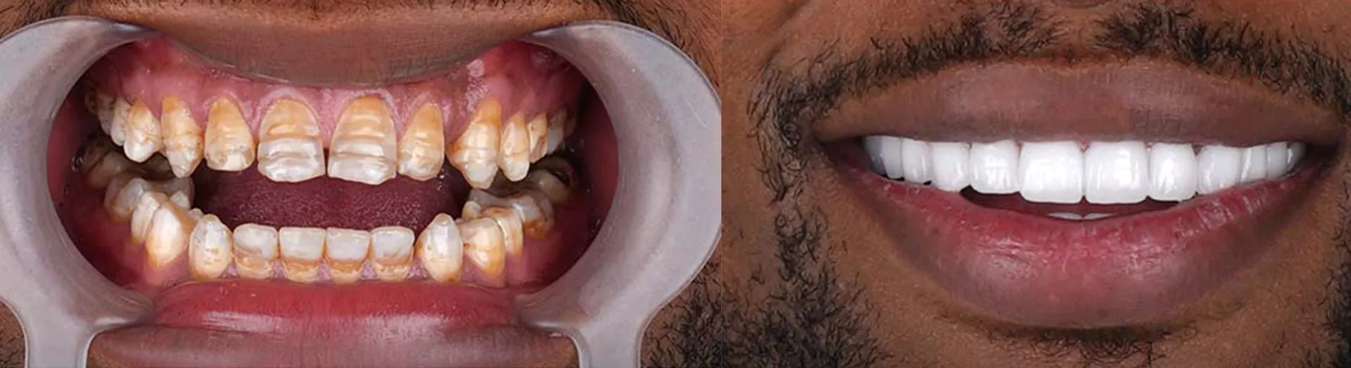 Hollywood Smile Package