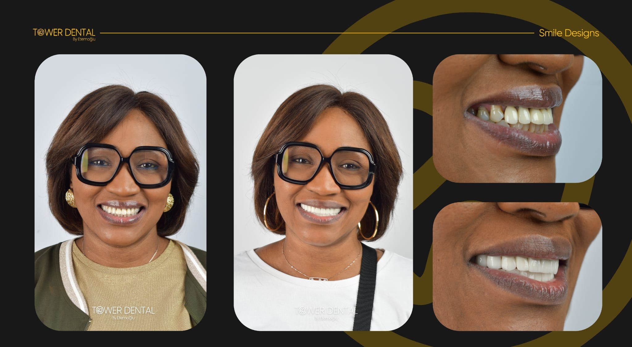 Veneers - Before and After