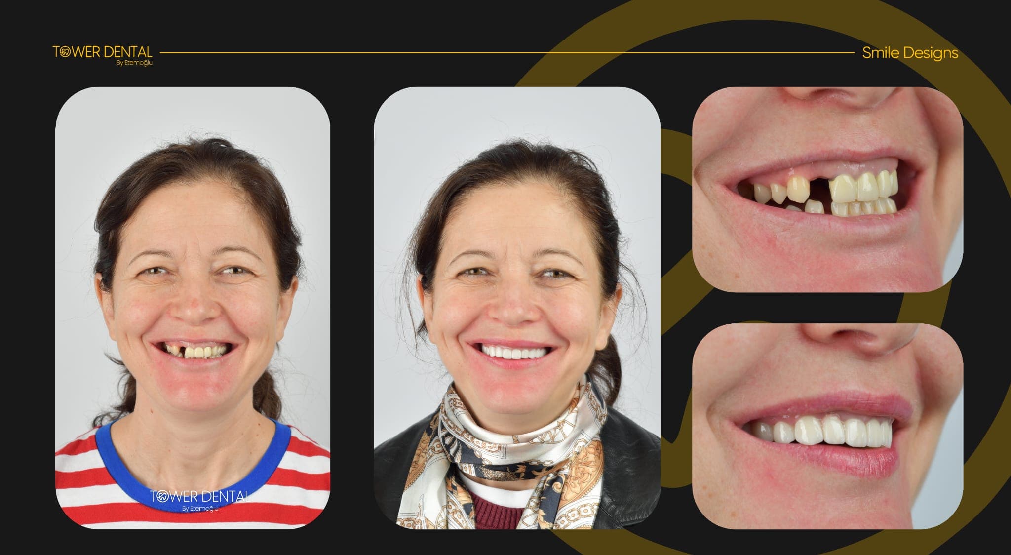Dental Bridge - Before and After
