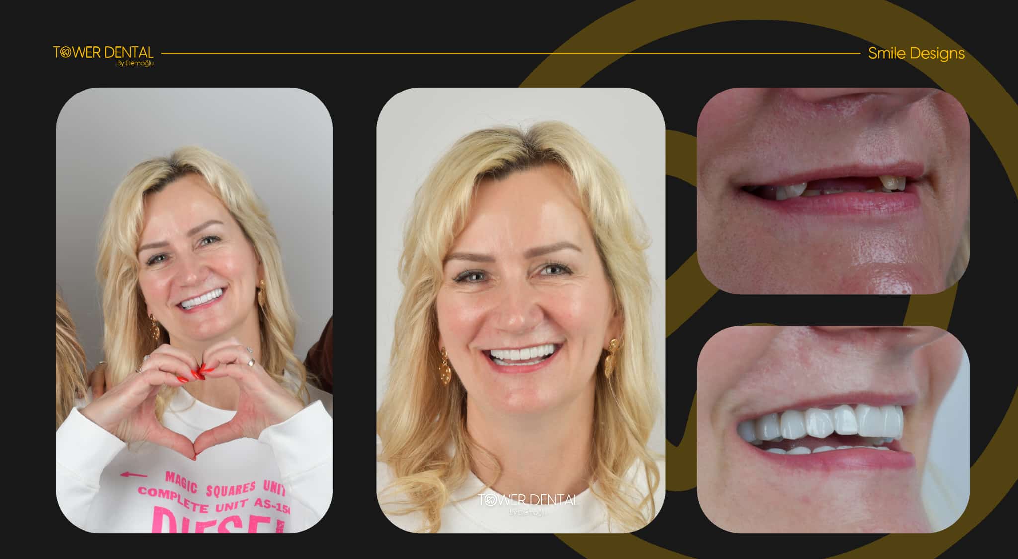 Dental Implants - Before and After