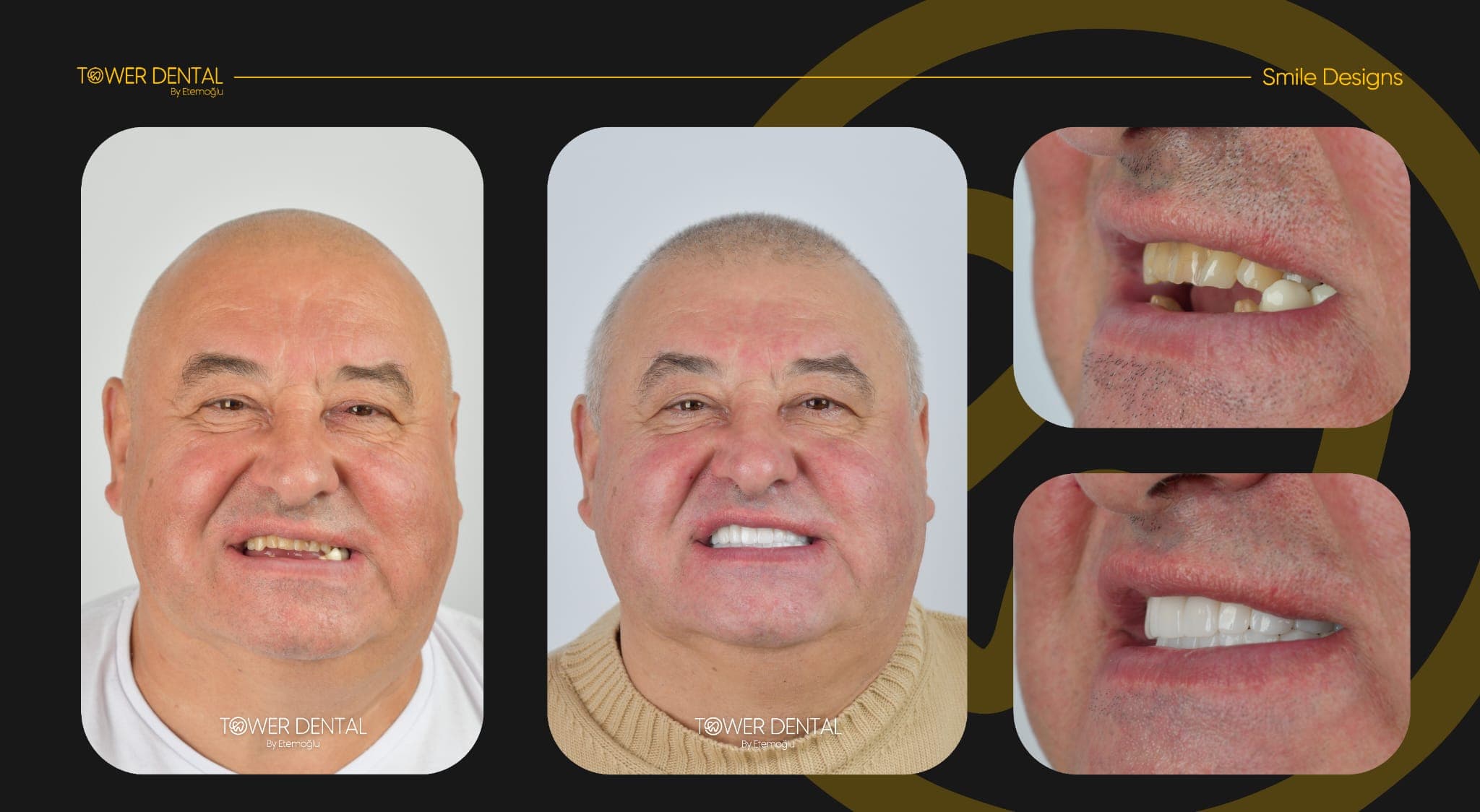 Crowns - Before and After