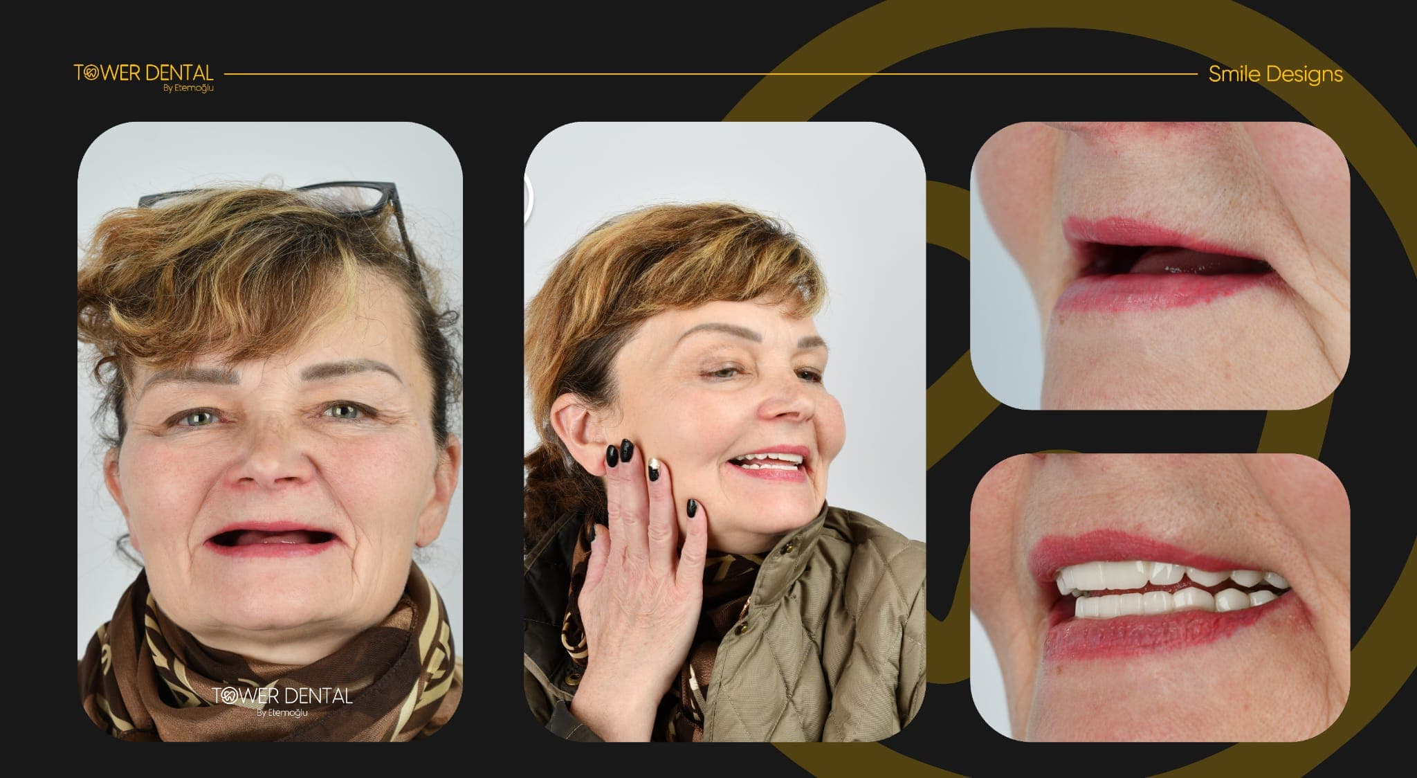 All-on-6 - Before and After