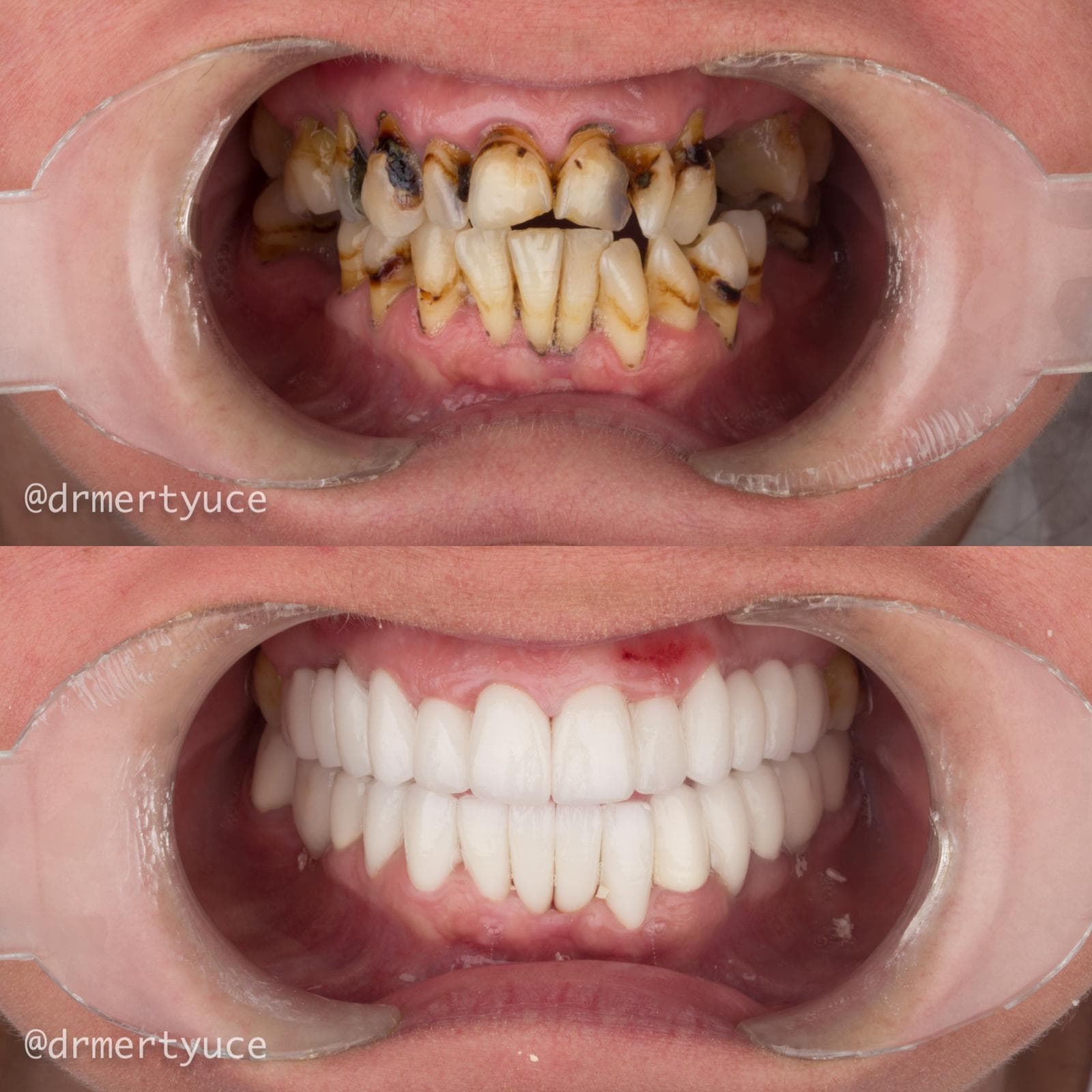 Crowns - Before and After