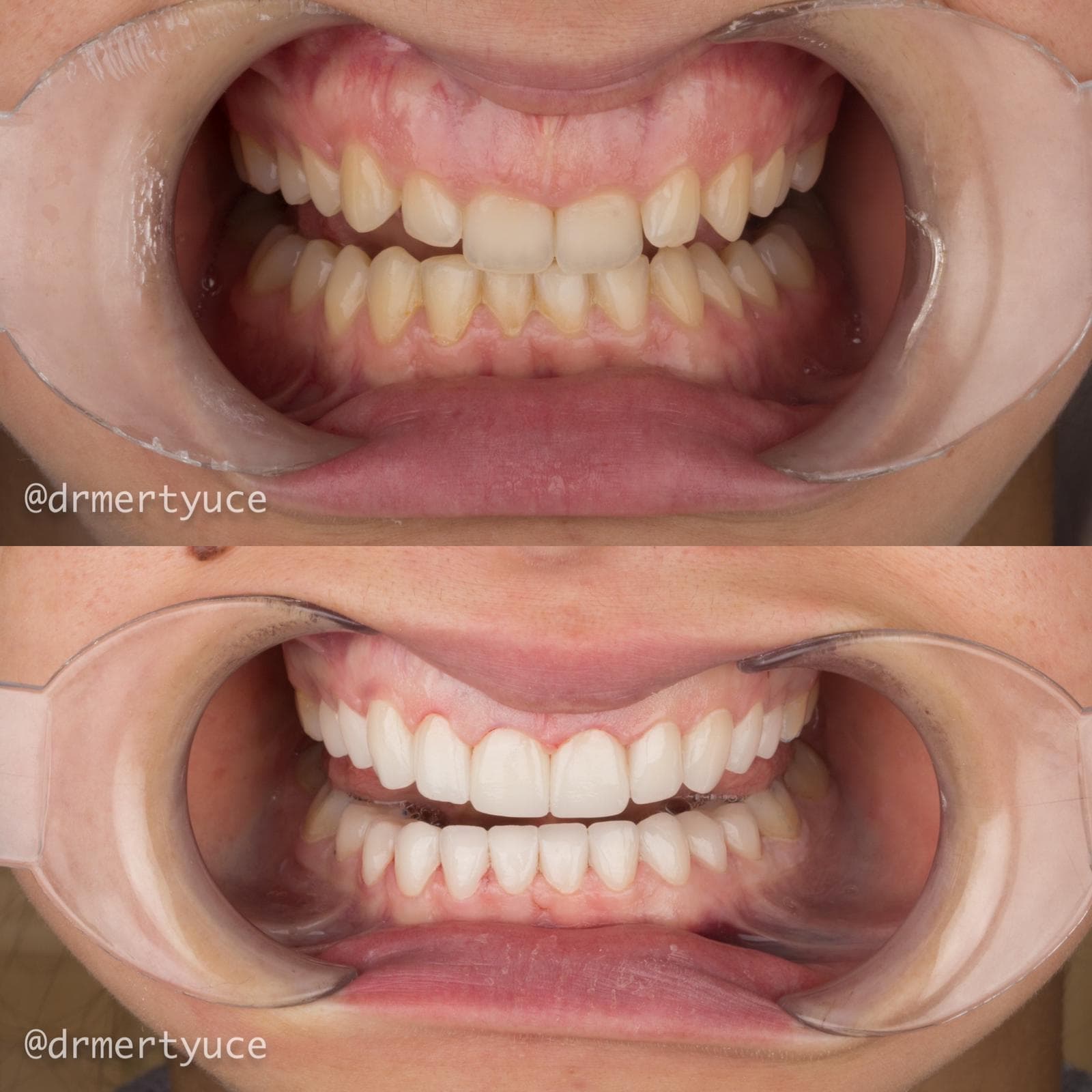 Veneers - Before and After