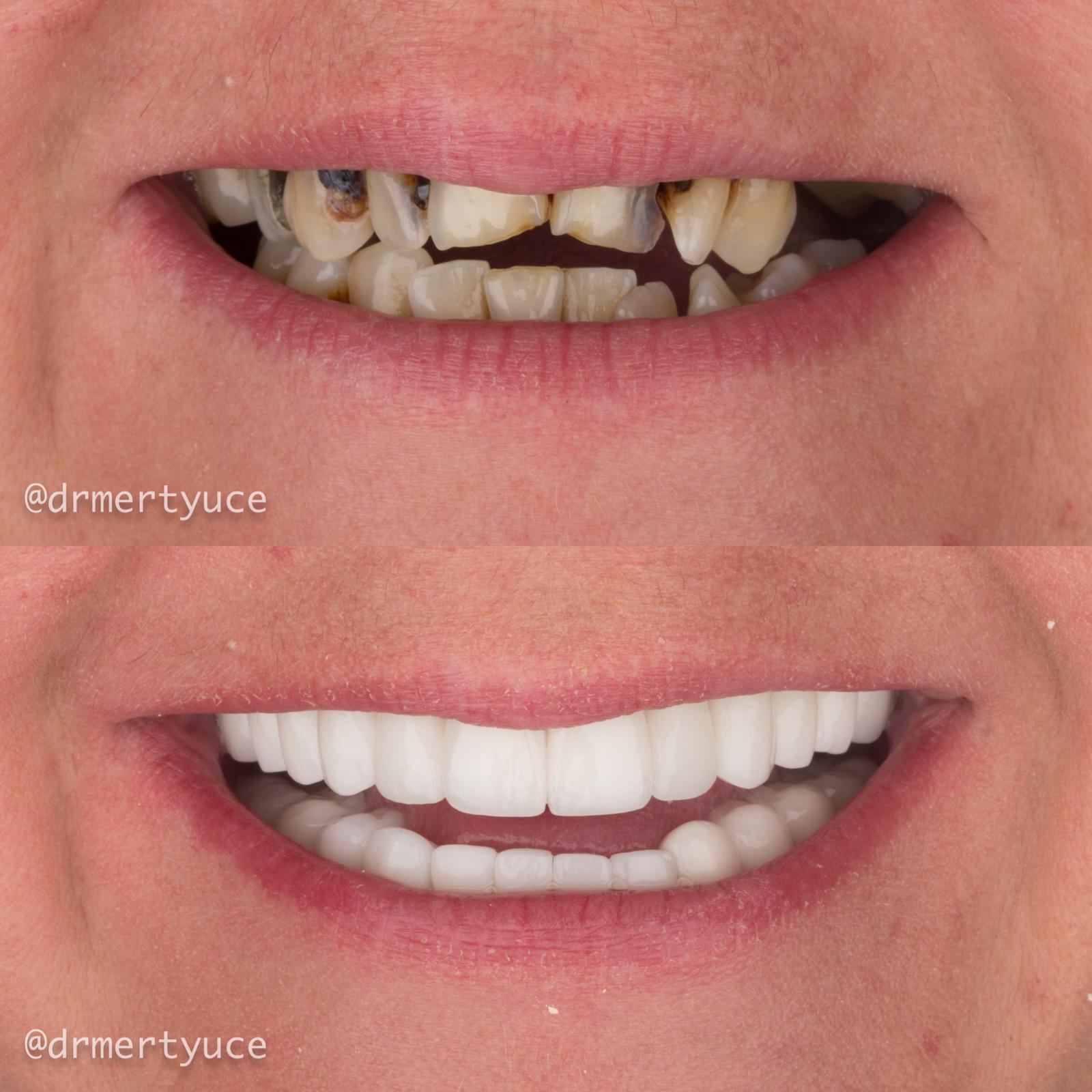 Crowns - Before and After