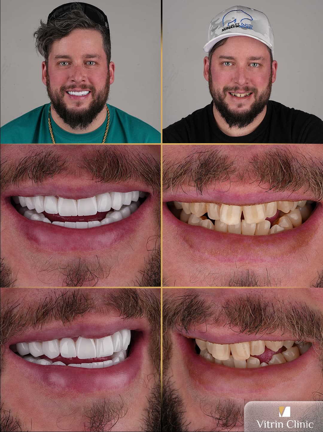 Hollywood Smile Package