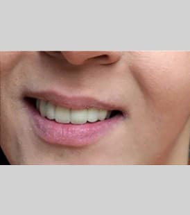 Crown Restoration Package