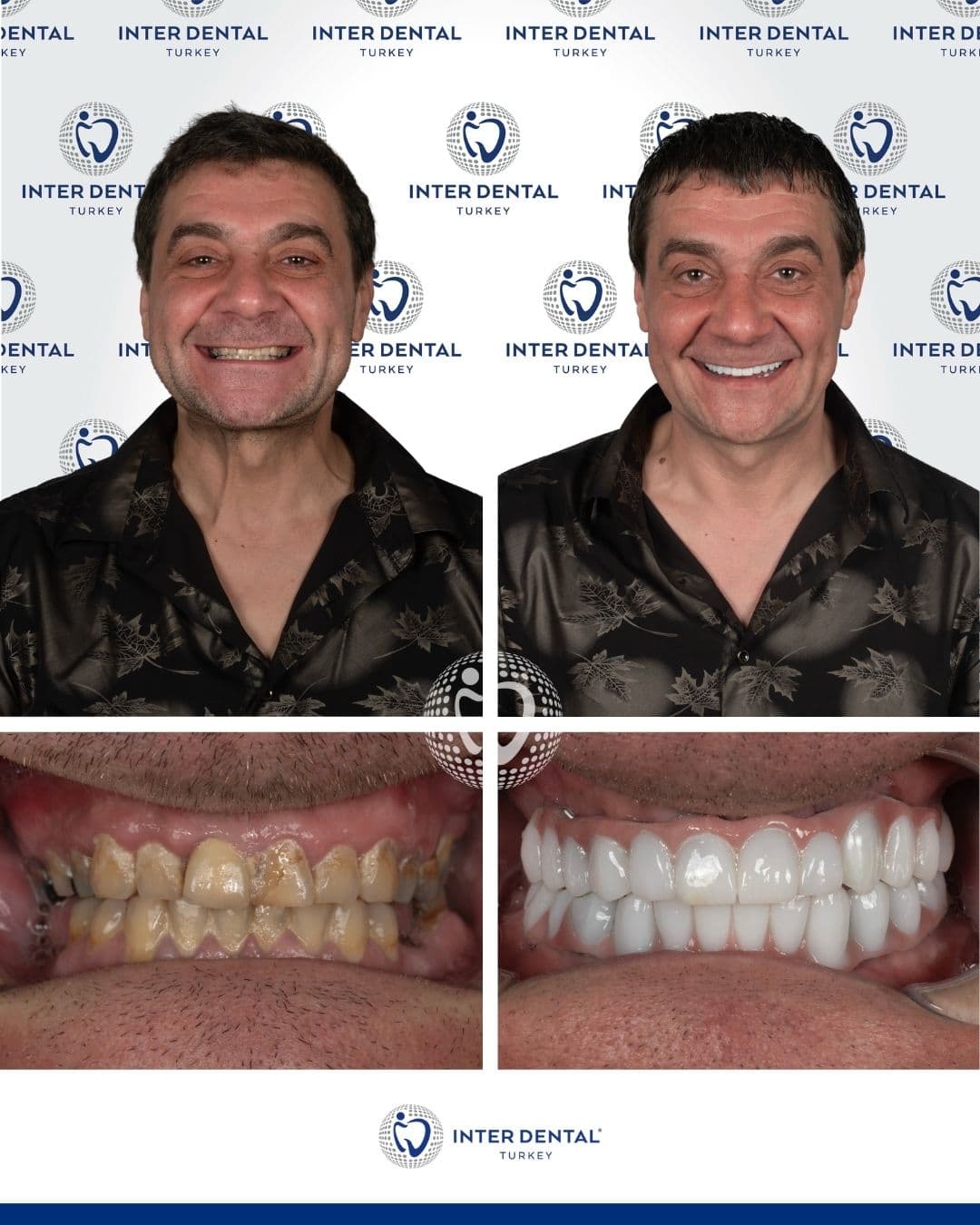 Crown Restoration Package