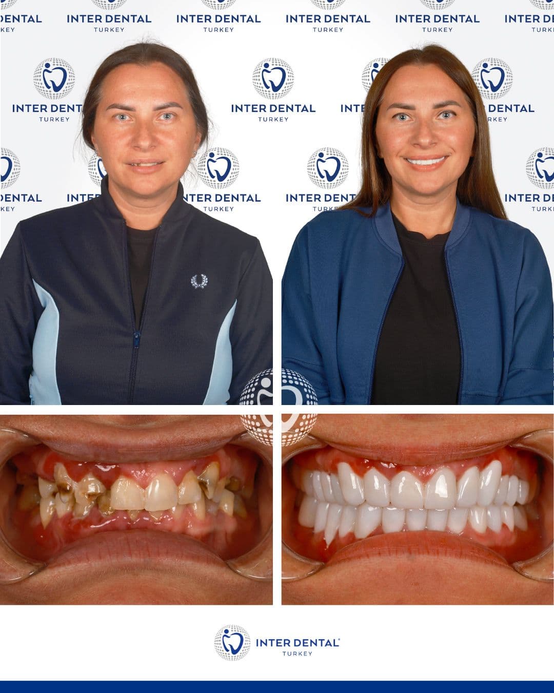 Hollywood Smile Package