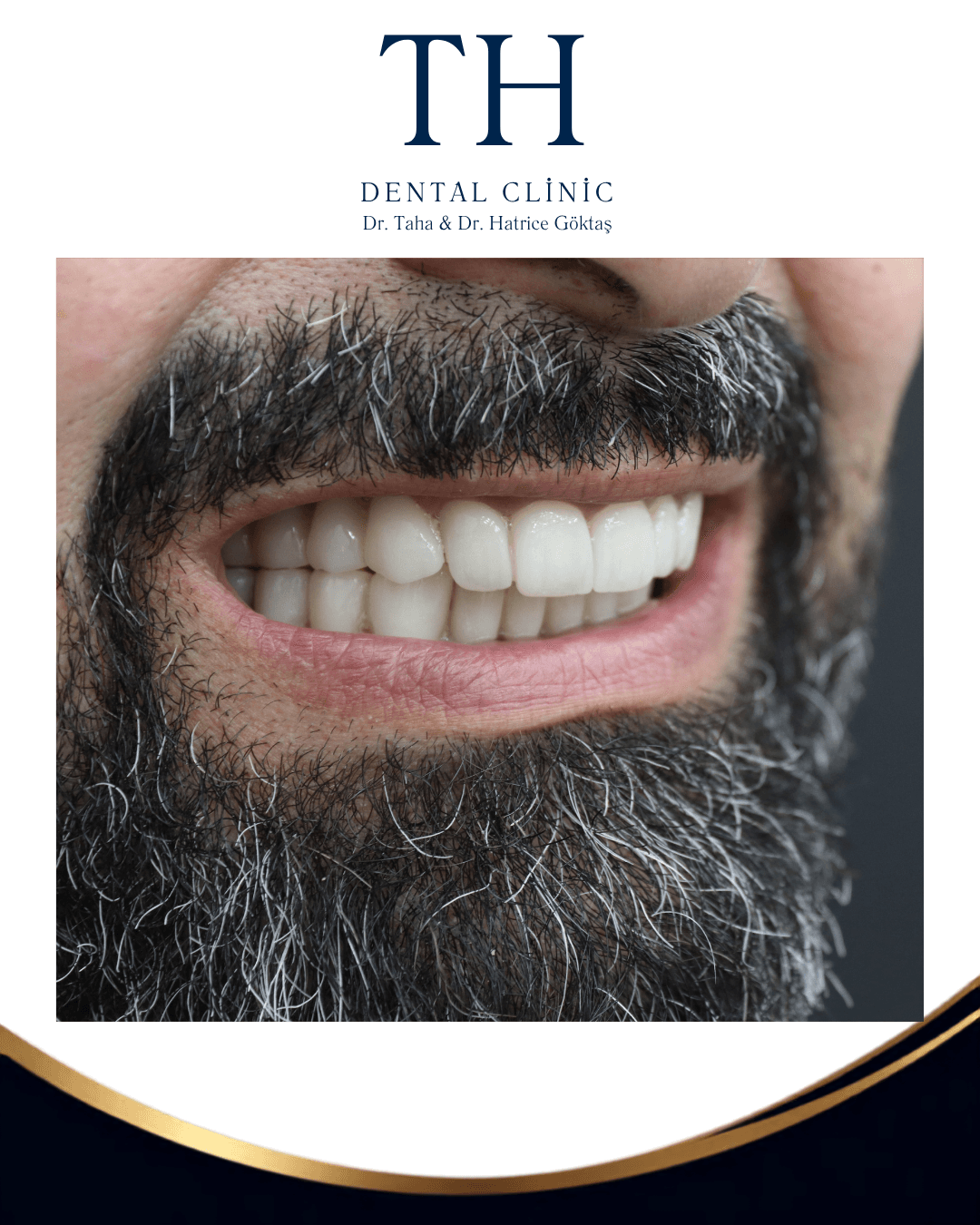 Hollywood Smile Package