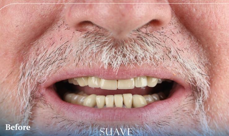 Before treatment